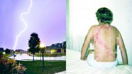 Víctimas de un rayo revelan impactantes imágenes de las marcas de su piel, en Estados Unidos 
